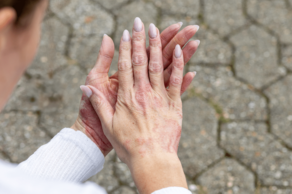 Elderly woman with rash on hands