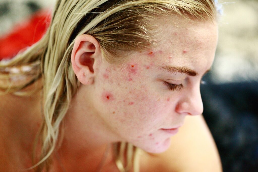 struggle, acne, skin, face, portrait, woman, people, reality, girl, female, model, hair, person, human, skincare, character, caucasian, blemishes, pimples, no make up, life, problems, issues, self esteem, brown love, brown life, brown model, brown hair, brown human, acne, acne, acne, acne, acne, pimples, pimples