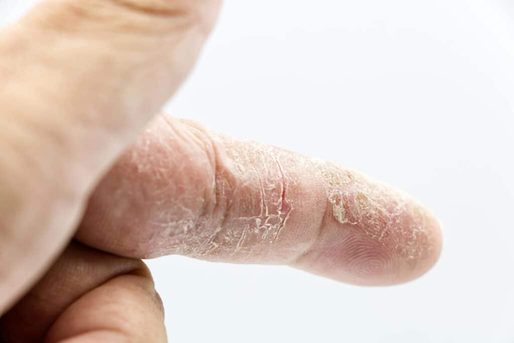 pexels-photo-12754952-12754952 Detailed close-up of a human finger with dry and calloused skin showcasing texture and skin condition.